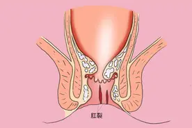 肛裂出现坐立难安，如何缓解？如何预防肛裂？图片