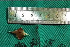 一个被误吞的片状鱼刺“旅行记”图片