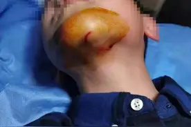 12岁男孩酒店内滑倒割破下巴，家长质疑设施不合理 海天大酒店：免房费赔医疗费图片
