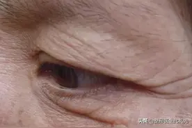姐妹们做过双眼皮后20年还能做提眉手术吗？图片