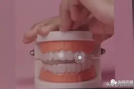 「记者调查」网购牙齿矫正器，真的靠谱吗？图片