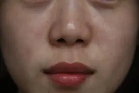 女性唇毛多，如何解决？图片