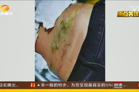 长沙女子到修脚店拔火罐，拔着拔着起火了，“技师却只知道哭”……图片