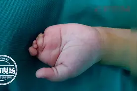 孩子出生左手只有1根手指！医生用这招，2年后手指长出来了图片