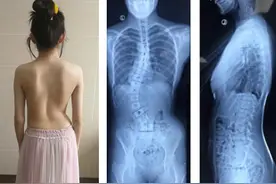 写作业时总是歪着身子？初二女生脊柱侧弯，呈S形改变图片