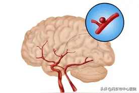 健康·科普 | 可防可治——缺血性脑血管病图片