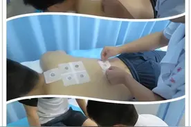 「冬病夏治」善用天时固阳气，三伏“天灸”防痼疾图片