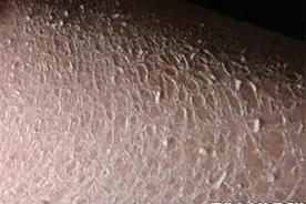 谈谈鱼鳞皮肤护理的那些事儿图片