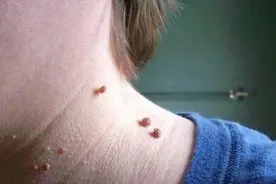解读｜皮肤长出一个个小肉球是怎么回事，可以抠掉吗？如何应对？图片