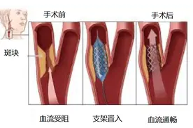 体检发现颈动脉狭窄，怎么办？图片