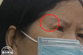 巴院长”包治各种疤？结果让女子用到“流泪”图片
