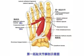 “踇外翻”不仅仅是脚丑图片
