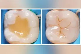 补牙“油水”有多大？如果想看牙省钱，请一字不落地看完图片