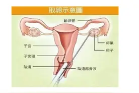 揭秘女性取卵全过程：明星代孕的背后，到底有多恐怖？图片