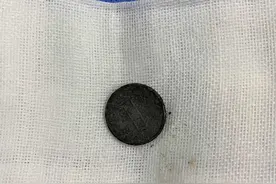 男孩吞下1角硬币13天 彩超里清晰看到“1” 孩子吞下异物应该马上就诊呢？还是观察一段时间？医生这样解答图片