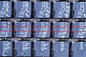 不慎高处坠落，导致腰2椎体爆裂性骨折、闭合性胸部损伤图片