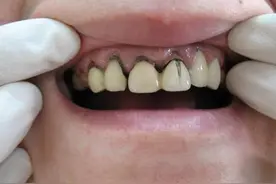 牙齿缺失尽量别做烤瓷牙，少花冤枉钱图片