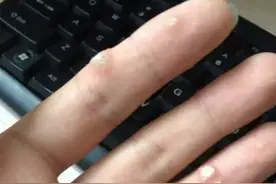 脸上长了像“金针菇”一样的东西，暗示身体得病啦？图片