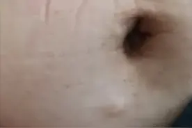 叫了N年的皮脂腺囊肿，原来是个误会图片