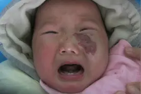 据说血管瘤可以自行消退，那么血管瘤需要治疗吗？图片