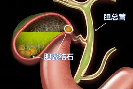 "胆大包天"：患有胆结石，吃药还是手术？结石多大需切胆？图片