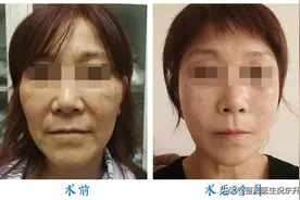 做面部五层提升手术，植入的提拉带被吸收后，靠什么维持效果？图片