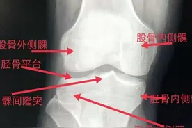 学习《X线读片指南》骨、关节系统——膝关节、胫腓骨图片