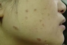 「科普」常见的皮肤“疣”有哪些？该怎么治疗？图片