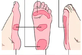 这是一条有味道的科普：“脚气”的药物治疗和日常护理图片