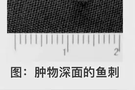 女子舌头肿胀险致癌！“罪魁祸首”竟是餐桌上常见的它……图片