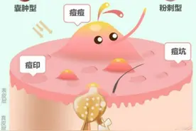 脸上痘痘反复长？这个根本原因，早知道就好了图片