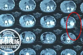 8岁孩子总腰痛，妈妈一直没在意！到医院一查问题真不小图片