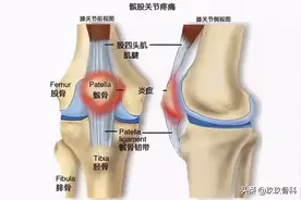 髌骨骨折后应注意什么？图片