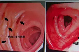 连续豪饮6天白酒后 他的肠道数次“血崩”了图片