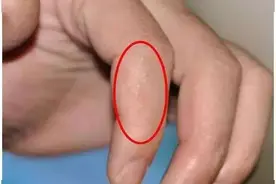 较痩来了，带你了解夏天手上经常起的小水泡是什么？图片