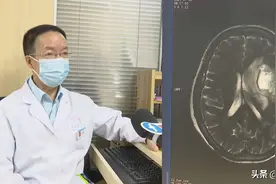 误把脑肿瘤当帕金森治疗，女子偏瘫半年，医生：这些症状要注意图片