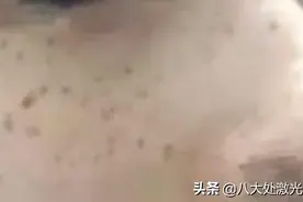 光子嫩肤——祛斑的心路历程图片