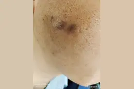 因工作琐事口角香烟烫脸，总经理涉嫌故意伤害被刑拘，已被免职记过，受伤职员称养伤期间4000元工资被扣图片