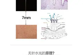 还在纠结要不要做「无针水光」?看完你就明白了图片