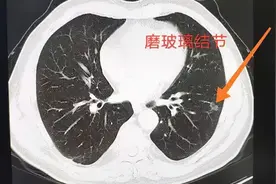 玻璃结节会癌变吗？图片