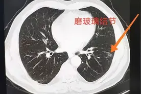 玻璃结节会癌变吗？图片