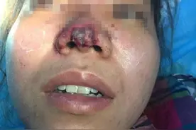 玻尿酸注射隆鼻，你后悔了吗？图片