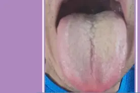 舌头有裂纹是怎么回事？常见的裂纹舌辩证，看看你是哪一种？图片