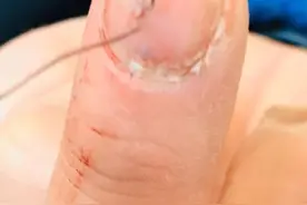 断针扎进手，疼得直发抖！图片