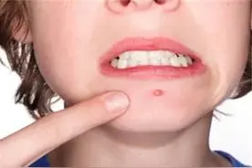 馨漫之舍揭秘闭合性粉刺成因图片