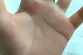 手汗症多年的她，却通过一台胸外科手术治好了——西安市红会医院胸部外科成功开展手汗症微创手术图片