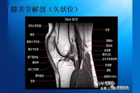 膝关节MRI解剖及半月板损伤影像诊断图片