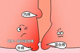 有内痔有外痔不等于就是混合痔！搞错这个问题，对治疗有影响吗？图片