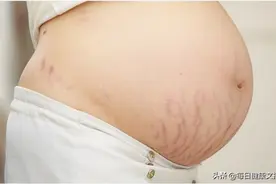 什么是妊娠纹？洛里洛塔小知识图片