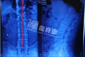 老年人扭伤腰，3次针灸就缓解症状图片